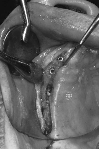만성치주염으로 인해 아주 좁아진 잇몸뼈에 광범위한 뼈이식 + 전체임플란트. 신사 레브치과. 관련 이미지 40