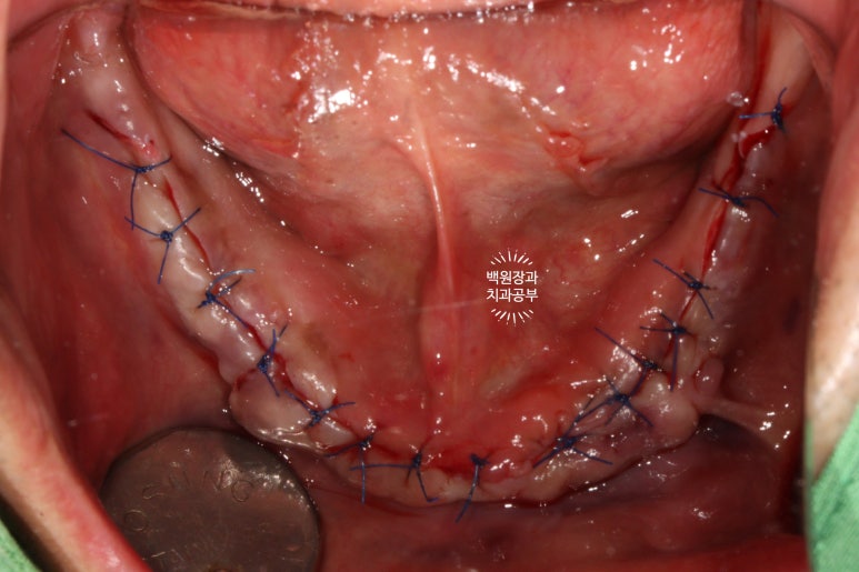 만성치주염으로 인해 아주 좁아진 잇몸뼈에 광범위한 뼈이식 + 전체임플란트. 신사 레브치과. 관련 이미지 36