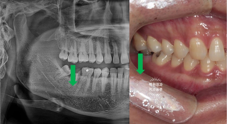 아래 어금니가 없어 위 어금니가 내려왔어요. 부분 교정을 곁들인 스트라우만 임플란트 수술. 억울한 신경치료를 피해보자. 치료과정/치료기간/비용/후기. 관련 이미지 4