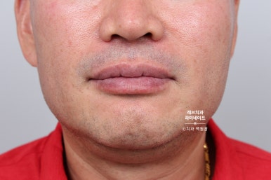 신사역 무삭제 라미네이트 : 레브네이트 내츄럴 최소삭제 비니어. 50대 앞니 벌어짐 비용/후기/얼굴사진. 관련 이미지 12