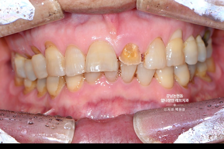 강남논현동치과 60대 치아부러짐 - 신경치료하고 기둥심고 앞니 크라운 잘하는곳! 가격/과정/후기/부작용. 관련 이미지 2