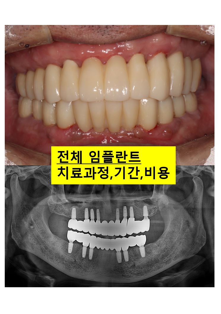 오스템임플란트 네비게이션 전체 임플란트 치료일기. 치료과정/치료기간/비용/솔직후기. 관련 이미지 1
