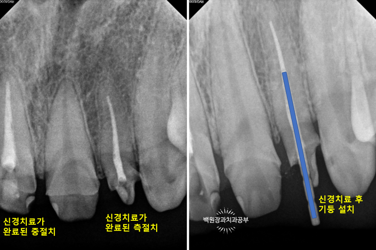 앞니에 잇몸염증과 충치가 심해요. 앞니 지르코니아 크라운 성공 후기. 치료과정/치료기간/비용/전후비교. 관련 이미지 14