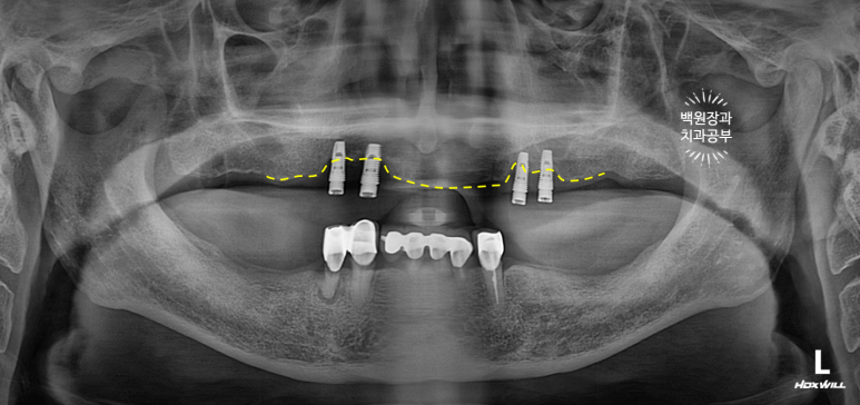 임플란트에서 고름이 나와요. 임플란트 주위염 그리고 재수술을 위한 준비. 치료과정/치료기간/비용/후기. 관련 이미지 3