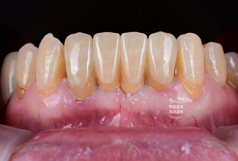 Seoul Sinsa Station [Lev Dental Clinic] For chronic periodontitis, extract the lower front teeth and make the crown look even more real than the real thing with an implant. image 11