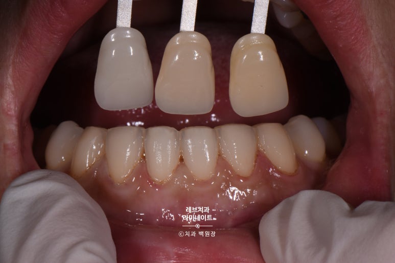 레브네이트 베이직. 치아미백과 치아교정을 한번에! 치아삭제 사진 있음. 신사역 치과 앞니라미네이트 모델/비용/후기. 관련 이미지 13