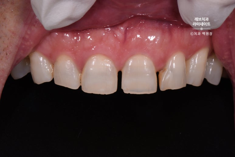 신사역 무삭제 라미네이트 : 레브네이트 내츄럴 최소삭제 비니어. 50대 앞니 벌어짐 비용/후기/얼굴사진. 관련 이미지 4