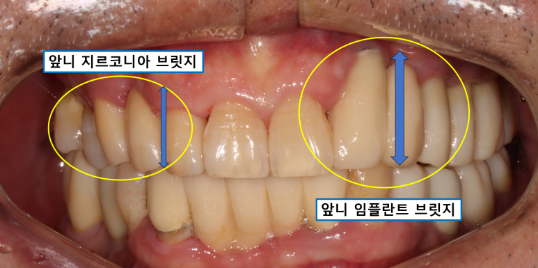 치주염 앞니 잇몸 염증으로 흔들릴 때 - 앞니 브릿지와 임플란트 장단점, 비용. 치료과정과 결과를 눈으로 보여주는 치과. 관련 이미지 18