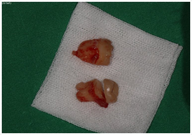 매복 사랑니 10분만에 뽑기! 치료과정/치료기간/비용/후기. 관련 이미지 1