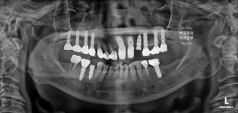 스트라우만 임플란트로 이뽑고 바로심는치과 - 믿고 사용하는 세계 1위 스위스 임플란트 회사. 관련 이미지 10