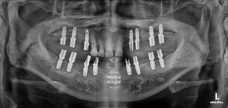 임플란트장인의 마음으로 8개월간 전체임플란트 완성. 치주과 전문의. 관련 이미지 21