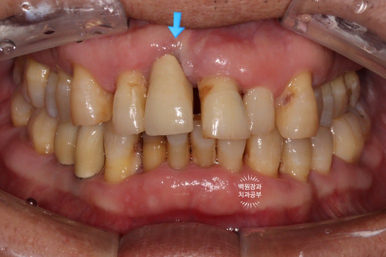 앞니 머리가 기둥째 부러졌어요. 발치 동시 뼈이식 오스템 BA 임플란트. 치료과정/치료기간/비용/후기. 압구정 치과. 관련 이미지 27