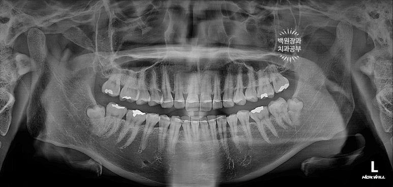 교정 유지장치 근처 앞니 옆면 충치 및 착색 간단히 3M 레진으로 치료. 치료과정/비용/후기. 과잉진료 없는 치과. 관련 이미지 7