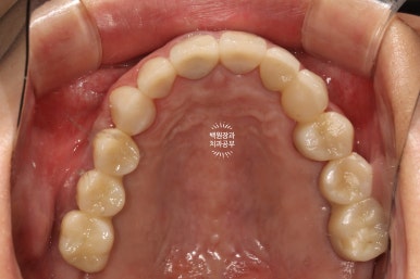 부분틀니 대신 어금니 임플란트를 만들어드립니다. 40대 어금니 상악동 뼈이식 임플란트. 치료기간/비용/과정. 관련 이미지 26