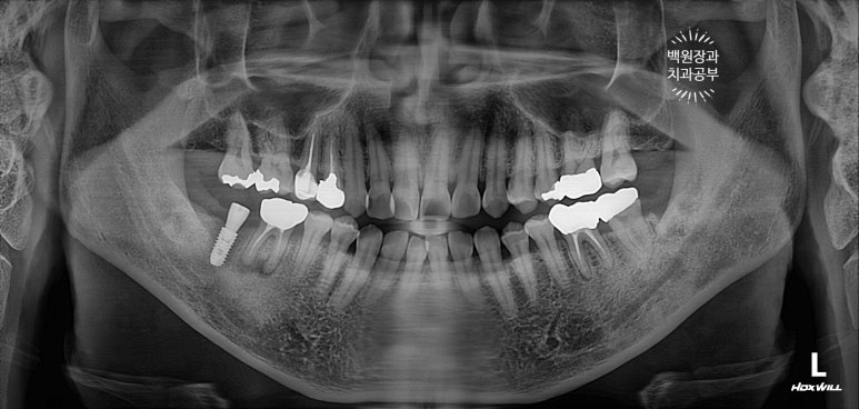 신경치료한 치아 부러짐! 뼈이식 하면서 임플란트 수술하는 과정/기간/비용. 관련 이미지 13
