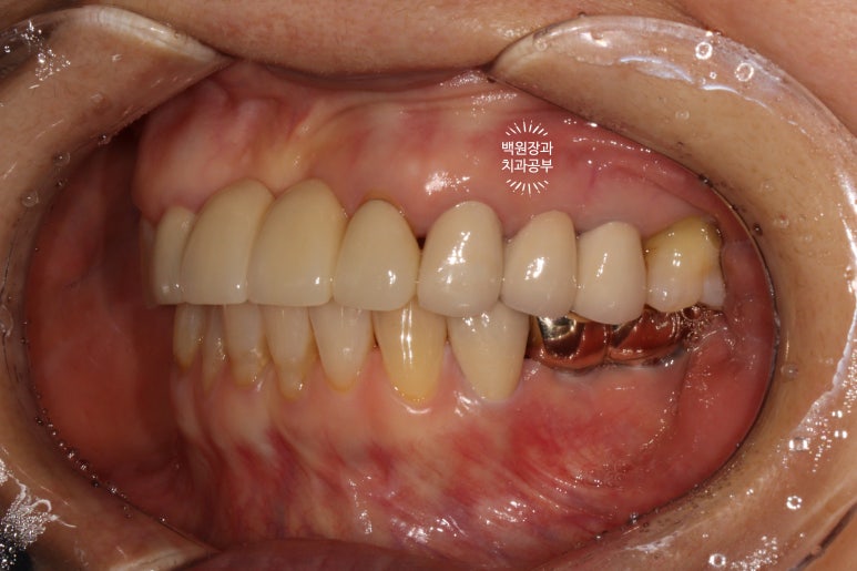 60대 임플란트 주변에서 고름이 나와요. 실패한 임플란트 제거 후 재수술. 덴티움 뼈이식재를 사용한 치조골 이식술. 관련 이미지 21