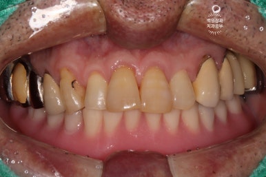 아래 어금니 임플란트 6개면 틀니를 안써도 됩니다.  치주염 전문 착한치과. 치료기간/임시치아과정/후기/비용. 관련 이미지 4