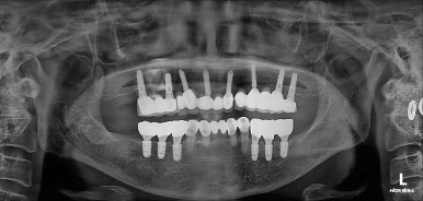 부분틀니를 오래써서 어금니가 아플 때, 아래턱 양쪽 어금니 임플란트 잘하는 강남임플란트치과 관련 이미지 34