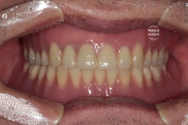 임플란트틀니 - 오버덴쳐. 오스템BA임플란트 이용한 최고의 가성비 치료. 치료과정/치료기간/비용/후기. 관련 이미지 22