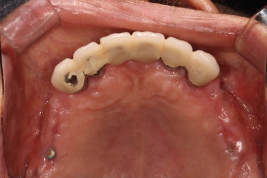 잇몸 염증 고름이 심했던 부위 - 만성치주염 진단하고 임플란트로 깔끔하게 치료! 신사역 치과 관련 이미지 19