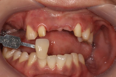 전세계 1위 스트라우만 임플란트를 사용한 어금니 기능회복과 앞니 지르코니아 크라운 증례. 관련 이미지 14