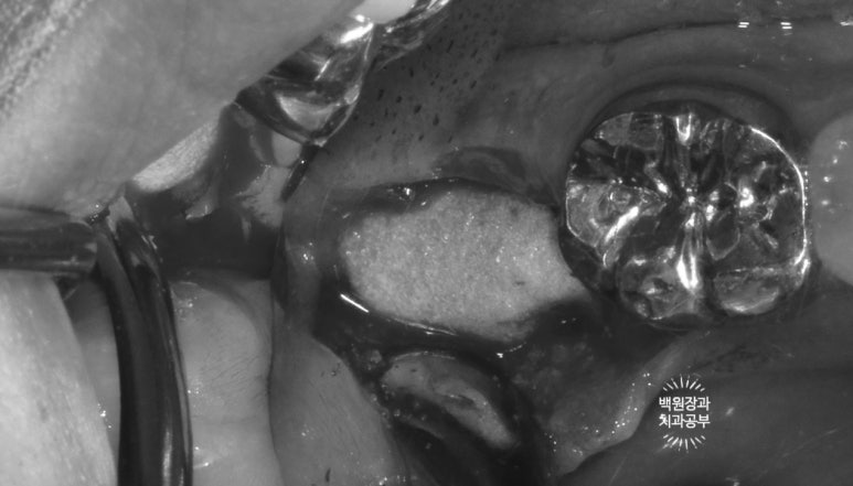 신경치료한 치아 부러짐! 뼈이식 하면서 임플란트 수술하는 과정/기간/비용. 관련 이미지 8