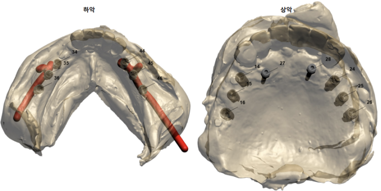 잇몸 염증 고름이 심했던 부위 - 만성치주염 진단하고 임플란트로 깔끔하게 치료! 신사역 치과 관련 이미지 14