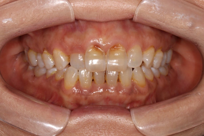 치아크랙 (금간 치아)의 찌릿한 통증 - 발치하지 않고 살려보기. 원인/진단/치료과정/비용/기간. 보존과전문의 치과. 관련 이미지 3