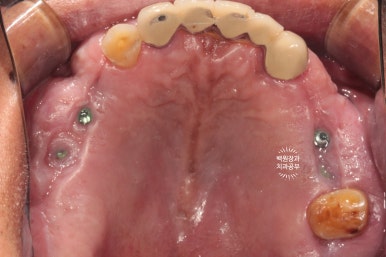 뿌리만 남은 앞니, 어금니가 없어 교합이 무너진 증례. 흡연자의 전체 오스템BA임플란트 재건증례. 치료과정/치료기간/비용/후기. 관련 이미지 14