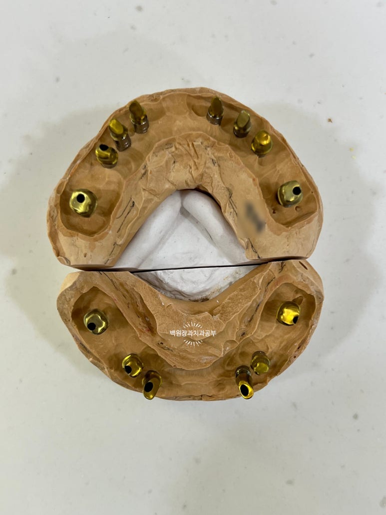 오스템임플란트 네비게이션 전체 임플란트 치료일기. 치료과정/치료기간/비용/솔직후기. 관련 이미지 31