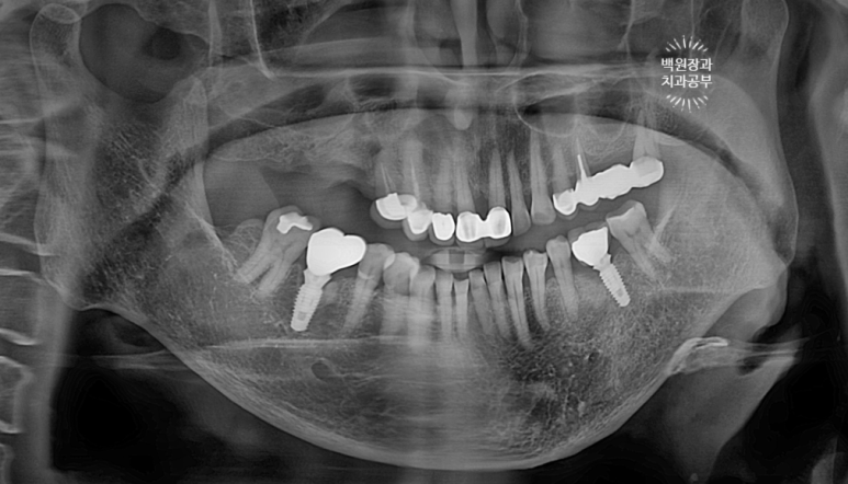임플란트에서 고름이 나와요. 임플란트 주위염 그리고 재수술을 위한 준비. 치료과정/치료기간/비용/후기. 관련 이미지 20