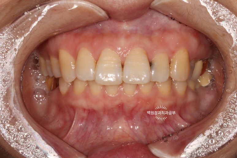 앞니레진치료 할 줄 모르는 치과의사는 없지만, 좋은 레진으로 치료하는 치과의사는 잘 없습니다. 관련 이미지 11