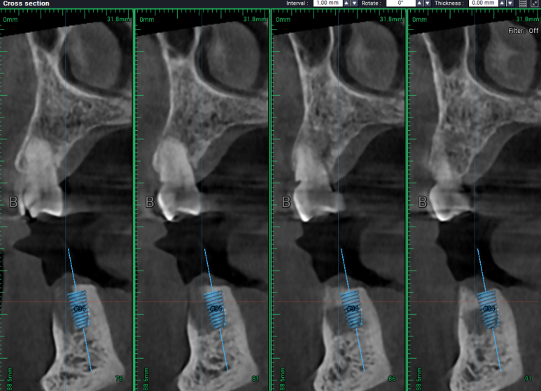 어금니 임플란트 주변 잇몸이식수술 - 저는 해야한다고 생각합니다. (feat. 대한치과의사협회 논문 + 치주과전문) 관련 이미지 13