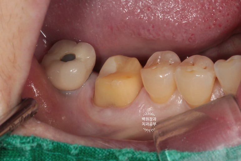 어금니 보철물이 떨어졌어요. 골드인레이 탈락 후 지르코니아 크라운으로 치료. 충치치료과정/치료기간/비용/후기. 관련 이미지 10