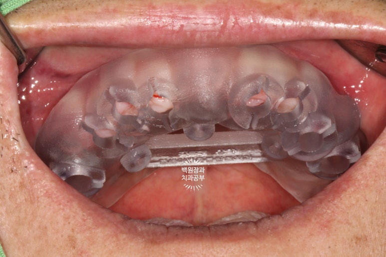 불편한 틀니를 아직도 쓰시나요? 전체 임플란트 치료비용/치료기간/치료과정. 관련 이미지 10