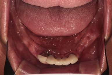 잇몸 염증 고름이 심했던 부위 - 만성치주염 진단하고 임플란트로 깔끔하게 치료! 신사역 치과 관련 이미지 13