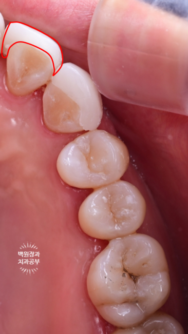 서울 신사역 [레브치과] 아래 앞니 치아 사이 틈 (블랙 트라이앵글) -  바이오클리어 치과에서 깔끔하게 해결. 관련 이미지 7