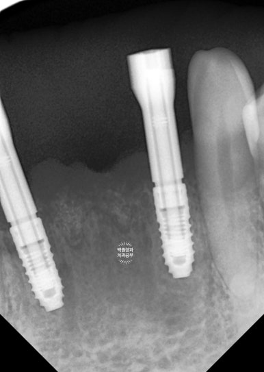 Seoul Sinsa Station [Lev Dental Clinic] For chronic periodontitis, extract the lower front teeth and make the crown look even more real than the real thing with an implant. image 8