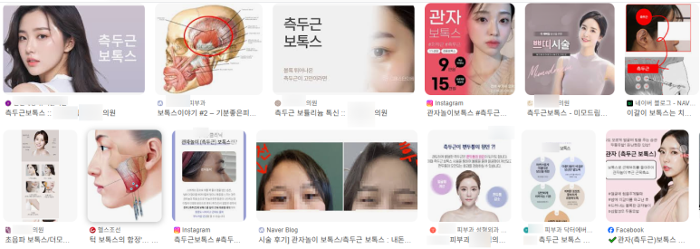 이갈이 마우스피스를 맞추기 전에, 저작근을 이해하고 측두근 보톡스를 맞아보세요! 관련 이미지 7