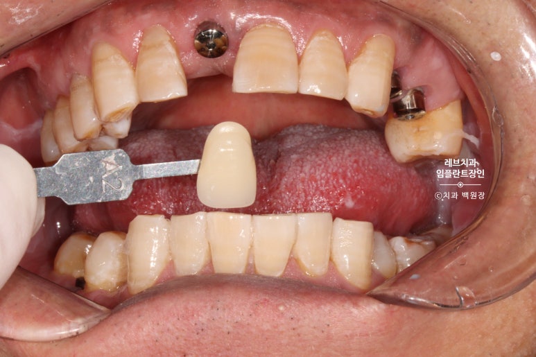 앞니 부러짐? 뽑고 바로 임플란트 + 뼈이식. 앞니 흔들림? 뽑고 1달 기다리고 임플란트 + 뼈이식. 신사역 치과 후기/비용/과정. 관련 이미지 8
