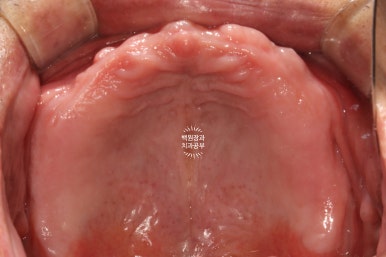 불편한 틀니를 아직도 쓰시나요? 전체 임플란트 치료비용/치료기간/치료과정. 관련 이미지 3