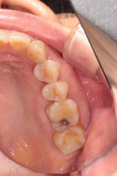 삐뚤어진 앞니를 8개월만에 가지런하게 만드는 50대 성인부분교정. 신사역 교정치과. 치료과정/기간/비용. 관련 이미지 5