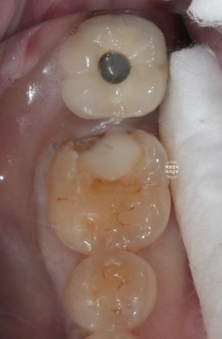 어금니 보철물이 떨어졌어요. 골드인레이 탈락 후 지르코니아 크라운으로 치료. 충치치료과정/치료기간/비용/후기. 관련 이미지 6