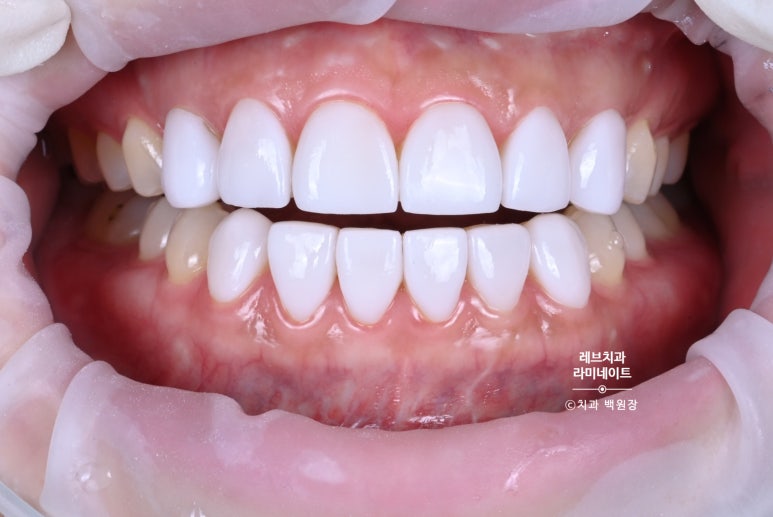 레브네이트 베이직. 치아미백과 치아교정을 한번에! 치아삭제 사진 있음. 신사역 치과 앞니라미네이트 모델/비용/후기. 관련 이미지 15