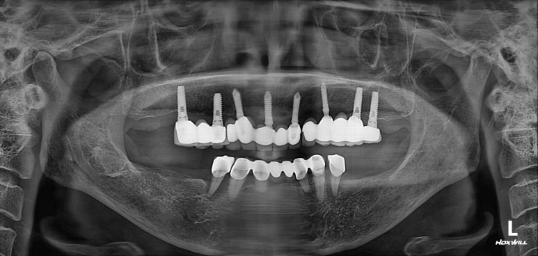 부분틀니를 오래써서 어금니가 아플 때, 아래턱 양쪽 어금니 임플란트 잘하는 강남임플란트치과 관련 이미지 2