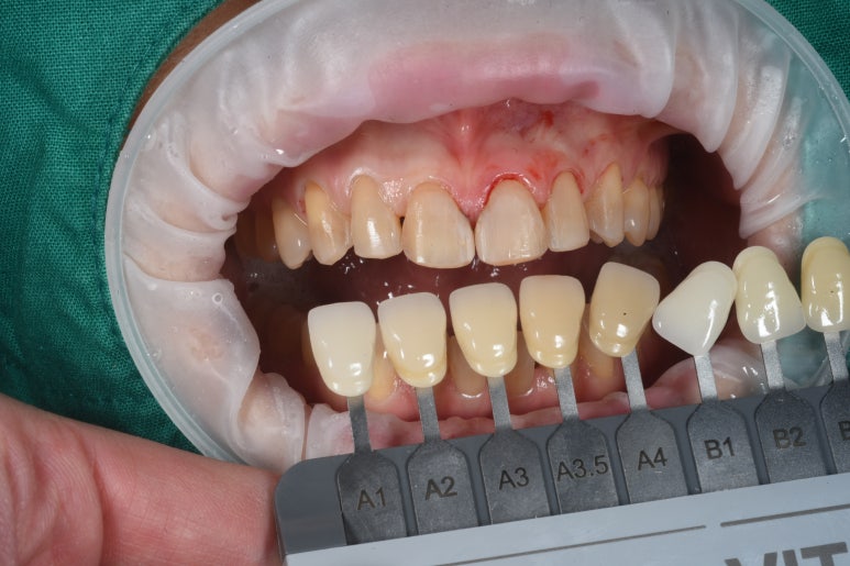 레브네이트 엑스퍼트 - 앞니 무삭제 라미네이트. 40대 벌어진 앞니에 변색된 레진은 이제 그만! 압구정 치과 추천 전후/비용. 관련 이미지 11