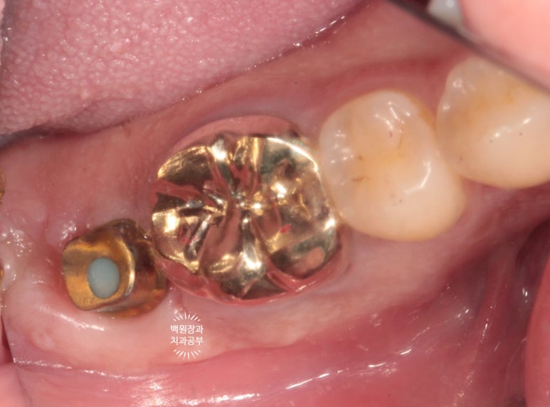 신경치료한 치아 부러짐! 뼈이식 하면서 임플란트 수술하는 과정/기간/비용. 관련 이미지 15