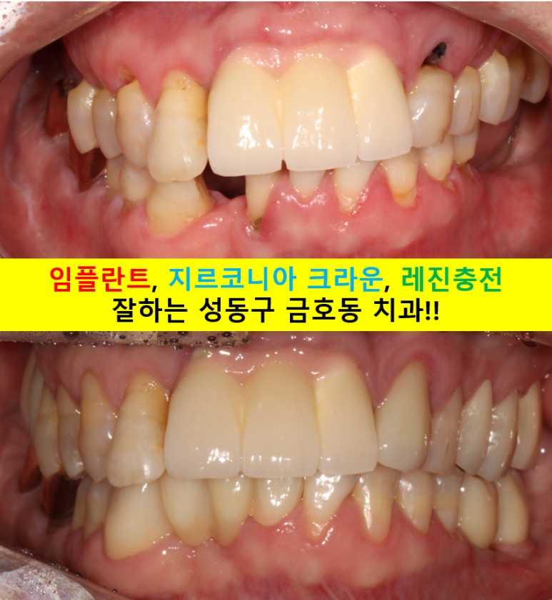 치주염으로 흔들리는 앞니부터 어금니 뼈이식 임플란트까지 - 5개월간 정성스러운 치료 과정. 관련 이미지 1