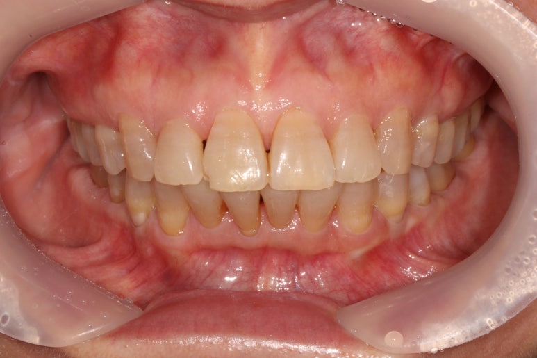 삐뚤어진 앞니를 8개월만에 가지런하게 만드는 50대 성인부분교정. 신사역 교정치과. 치료과정/기간/비용. 관련 이미지 24