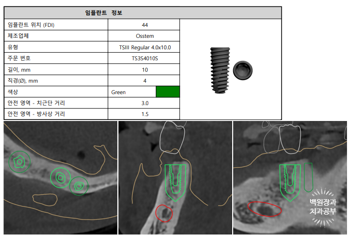 만성치주염으로 인해 아주 좁아진 잇몸뼈에 광범위한 뼈이식 + 전체임플란트. 신사 레브치과. 관련 이미지 19